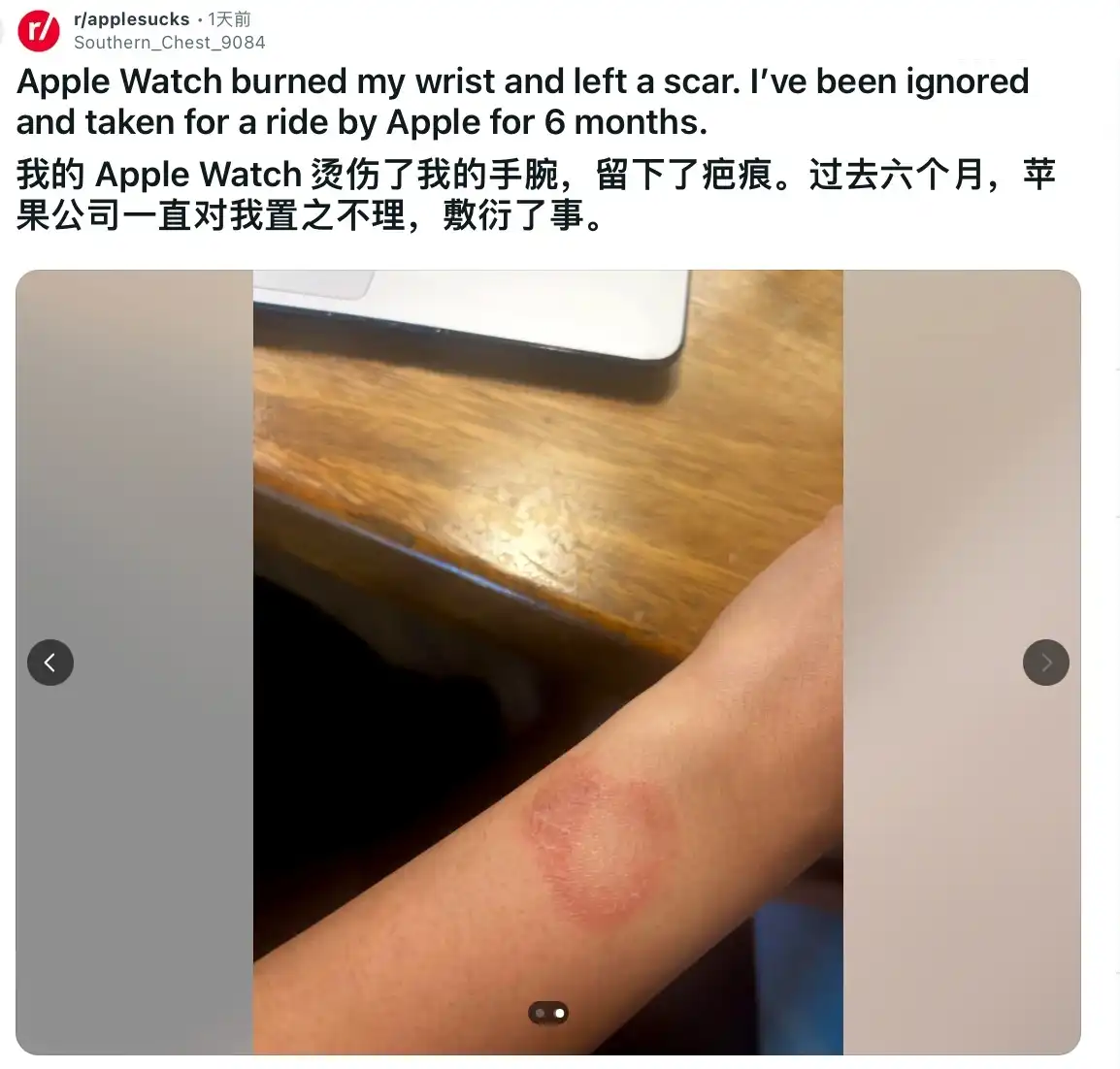 印度用户被苹果 Apple Watch 手表灼伤手腕,维权半年无果插图 印度用户被苹果 Apple Watch 手表灼伤手腕,维权半年无果插图